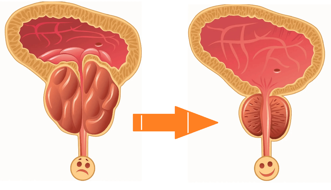 Uromexil Forte Acción sobre a próstata con prostatite e adenoma