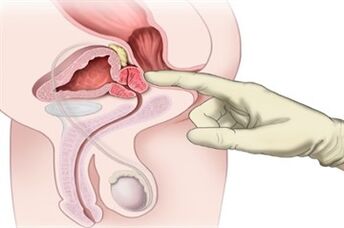 Masaxe de próstata para o tratamento da prostatite crónica