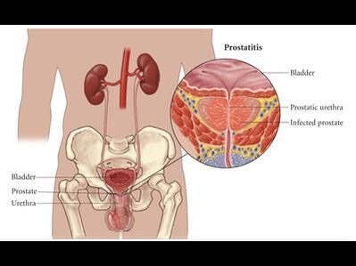 Prostatite - inflamación da glándula prostática